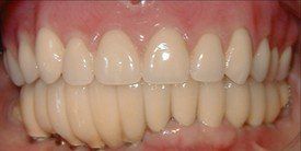upper/lower arch rehabilitation before