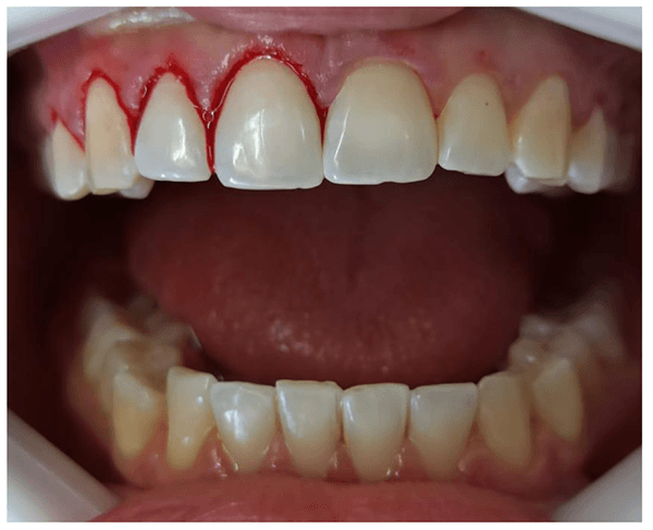 Gengivoplastia Gengivoplastia