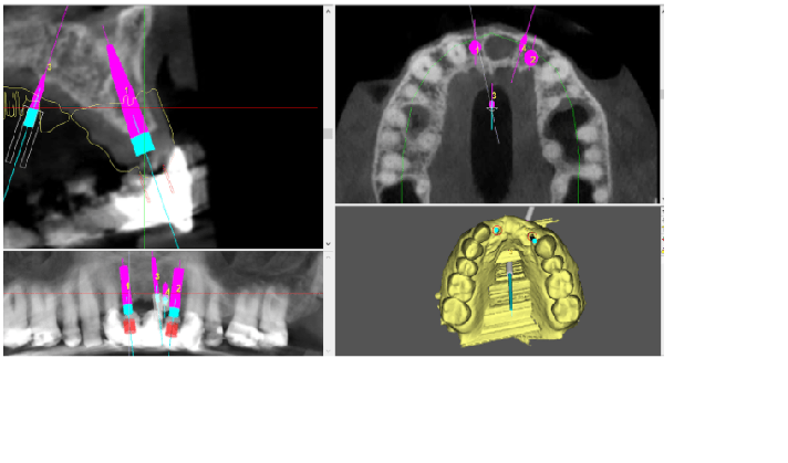 Planejamento virtual de implante dentário Planejamento virtual de implante dentário