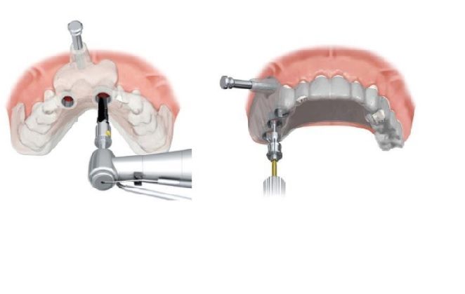 Implante dentário sem pontos