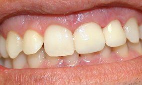 After Salgra Dental Porcelain Veneers