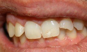 Before Salgra Dental Porcelain Veneers