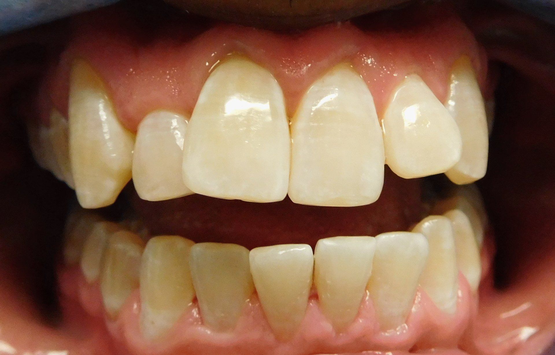 Before Salgra Dental Porcelain Veneers
