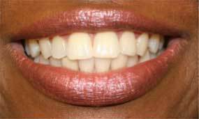 After Salgra Dental Porcelain Veneers