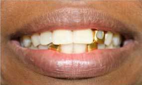 Before Salgra Dental Porcelain Veneers