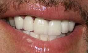After Salgra Dental Full smile restoration