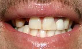 Before Salgra Dental Smile Reconstruction