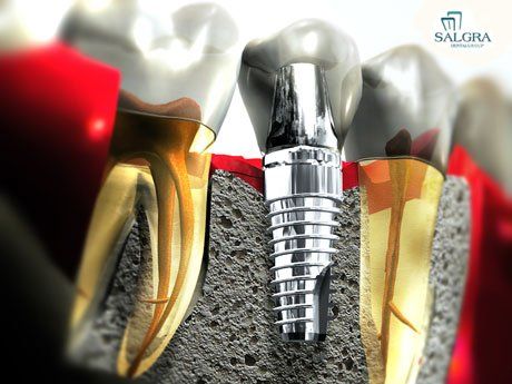 Dental Implants 