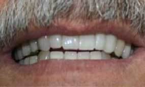Great Smile! Removable Dentures