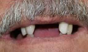 Before Salgra Dental Removable Dentures