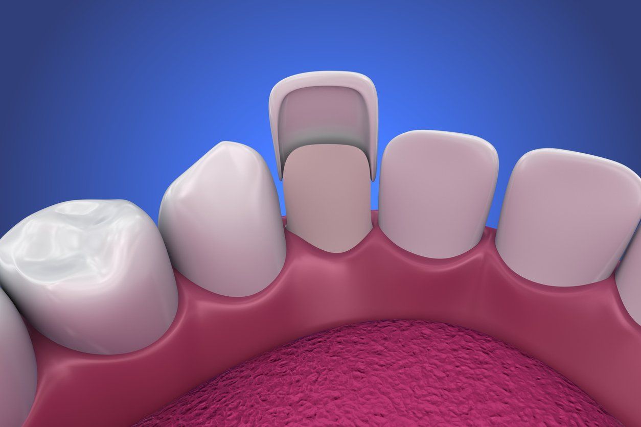 dental veneer illustration