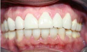 Another Salgra Dental Smile restorative invisalign and crowns, teeth whitening
