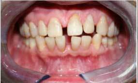 Before Salgra Dental Porcelain Veneers