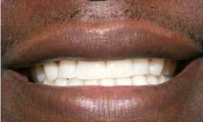 After Salgra Dental Clear Braces - Invisalign