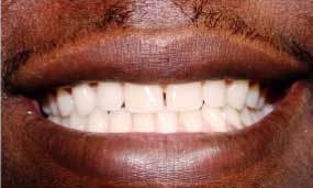 Before Salgra Dental Clear Braces Invisalign