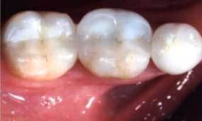 After Salgra Dental Same day Porcelain Restauration