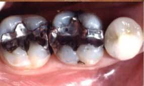 Before Salgra Dental Porcelain Restauration