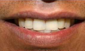 After Salgra Dental restorative dental implant