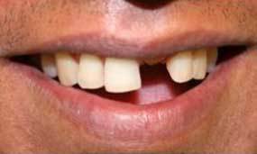 Before Salgra Dental Restorative Dental Implant