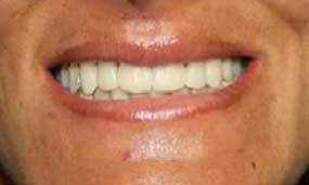 After Salgra Dental Same Day Porcelain Veneers