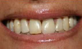 Before Salgra Dental Porcelain Veneers