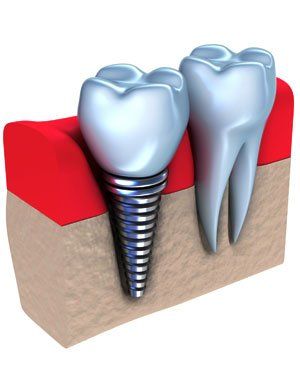 teeth implants