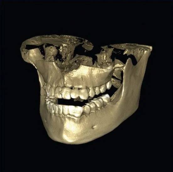 calco dentale