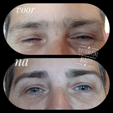 Brow Treatment