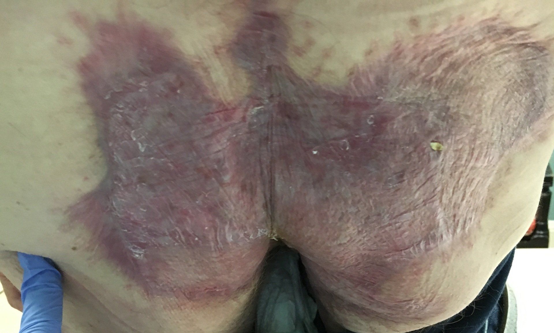 Buttocks with large, discolored areas of purple-red skin, possibly a skin condition or injury.