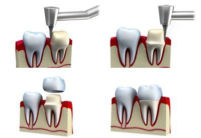 Dental Crown Procedure