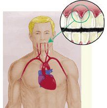 periodontal disease