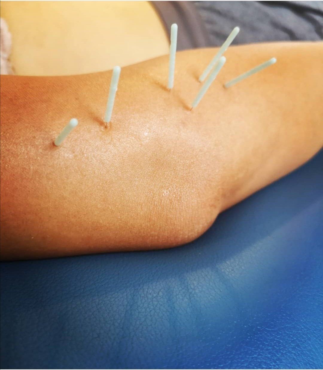 A person has acupuncture needles in their arm