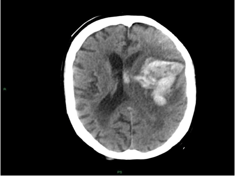 CT, amiloidoza