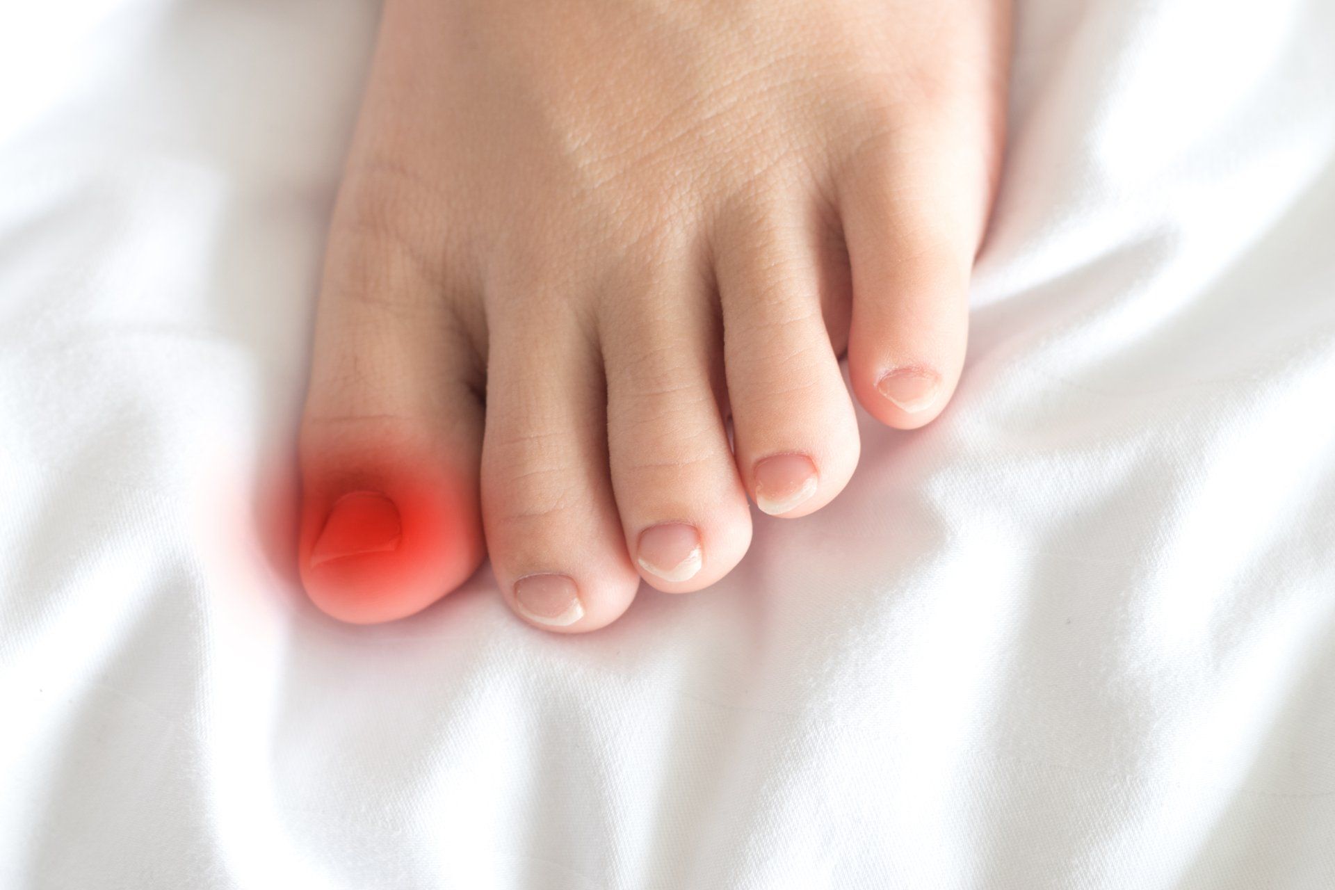 Ingrown Nail - Acacia Podiatry in Parap, NT