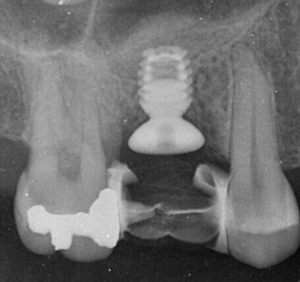 lastra dentale