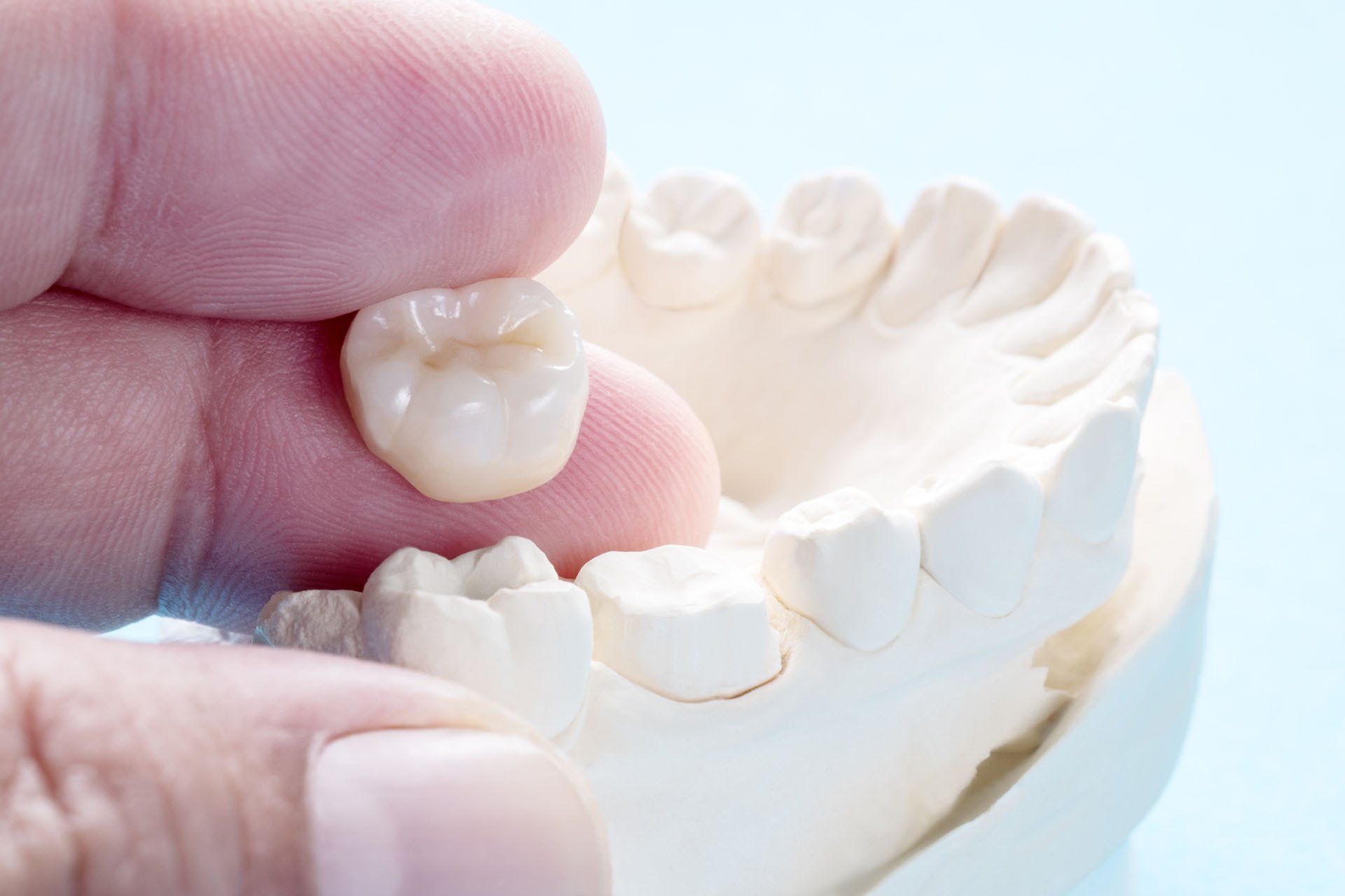 Crown Prosthodontics — Monticello, MS — Oak Lane Family Dental