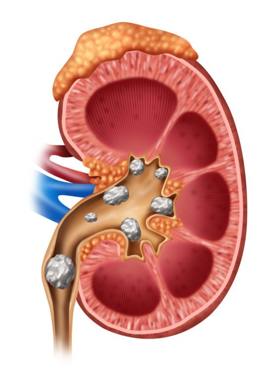 Kidney stone, urinary stone, ureteric stone, renal calculi, renal colic, nephrolithiasis