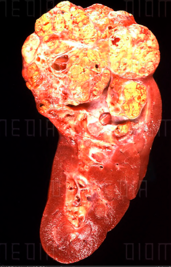 Kidney cancer, gross specimen, macroscopic appearance, bivalved specimen