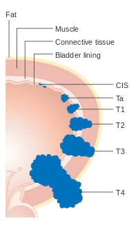 T staging, bladder cancer