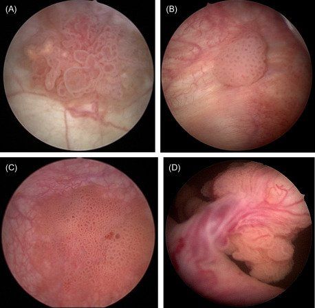 cystoscopy, bladder cancer, bladder tumour
