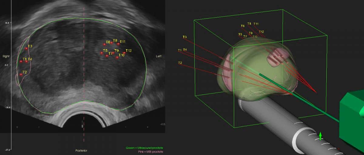 MRI Fusion biopsy, transperineal biopsy, prostate cancer diagnostic work up