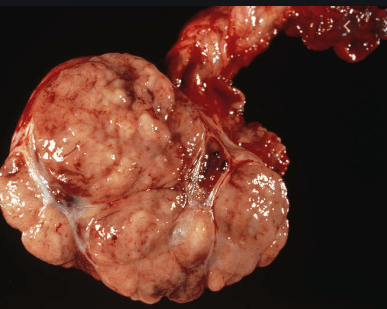 testis cancer, gross specimen, macroscopic appearance, bivalved specimen
