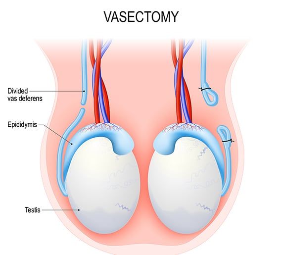 vasectomy