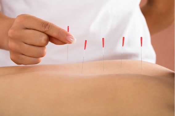 Acupoint Family Wellness Acupuncture Needles