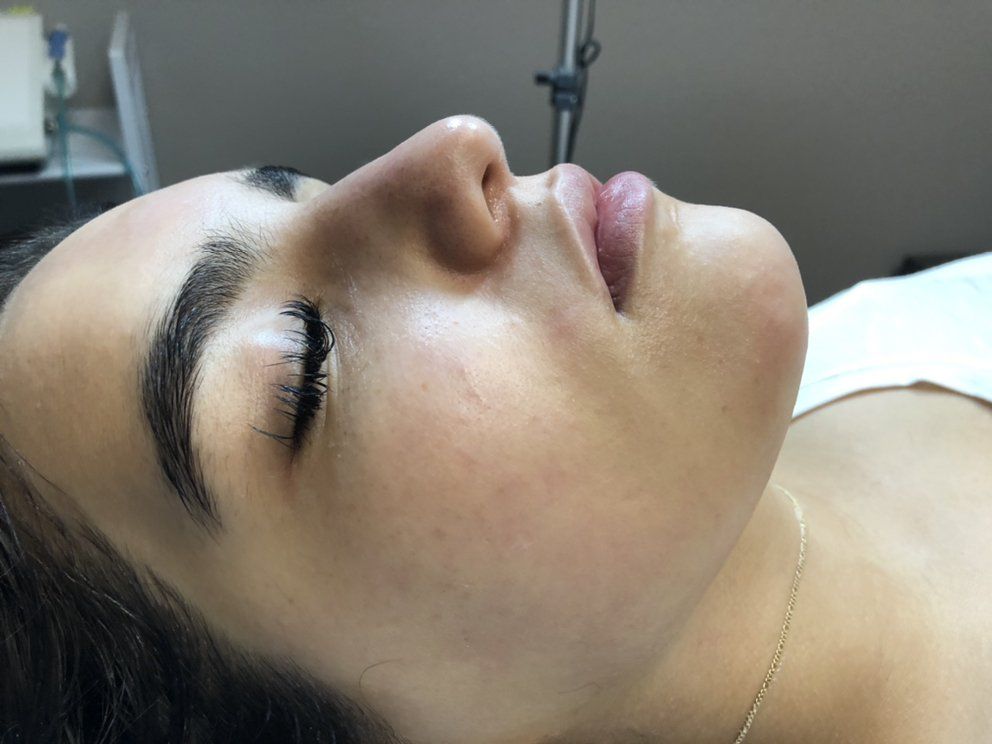 Dermaplaning Treatment — Tucson, AZ — Dalina’s Threading & Skincare