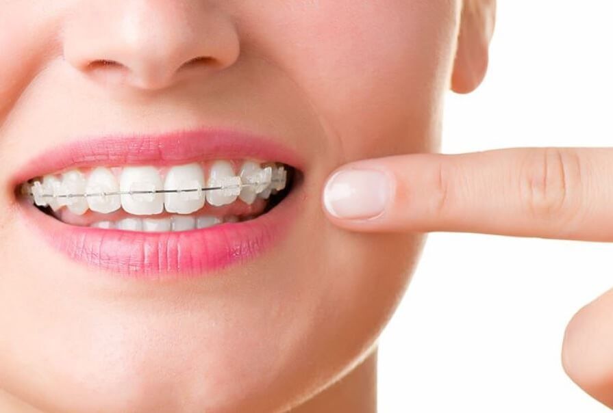 Damon Clear Braces Image | Orthodontist in Overland Park, Olathe, Spring Hill, KS