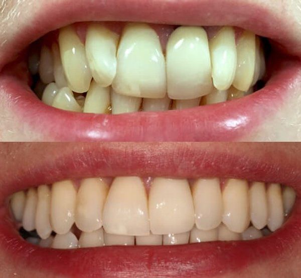 Before and After of Invisalign | Overland Park, Olathe, Spring Hill KS Invisalign treatment in Olathe, Overland Park KS and Spring Hill