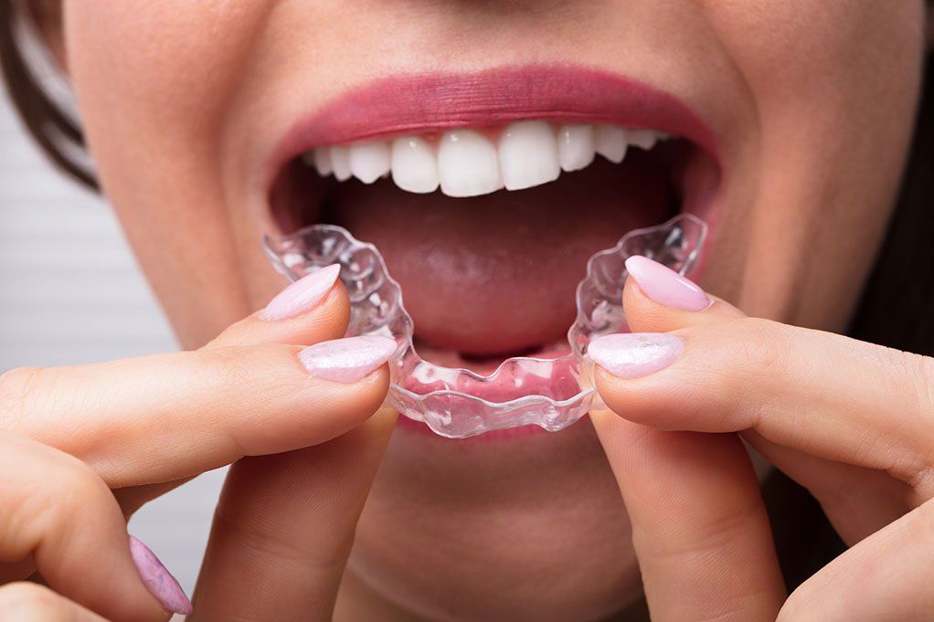 Get straighter teeth with Invisalign clear aligners Invisalign braces in Olathe, Overland Park and Spring Hill