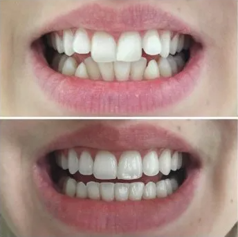 Before and After of Invisalign | Overland Park, Olathe, Spring Hill KS Invisalign results in Olathe, Overland Park and Spring Hill KS
