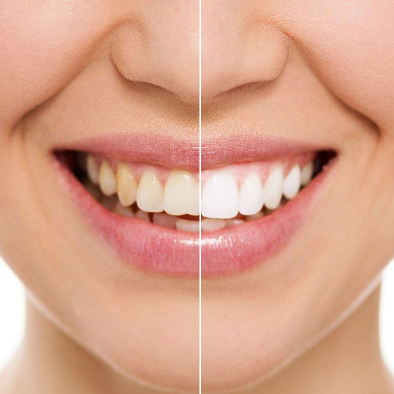 Teeth Whitening Before & After